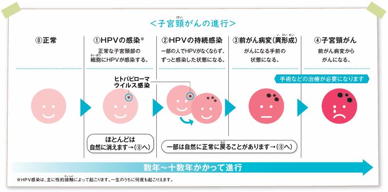 子宮頸がんの進行の画像