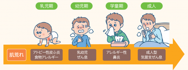 赤ちゃんの肌荒れとアレルギーマーチの画像